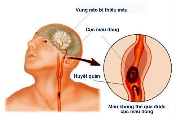 Sau 40 tuổi, nếu xuất hiện 4 dấu hiệu khi ngủ hãy cẩn thận đột quỵ: Đừng cố ngủ tiếp kẻo 'giấc ngàn thu'